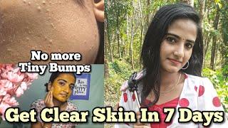 Remove Tiny Bumps on your face in 7 days /Clear Skin/Aleena's Diaries