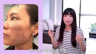 #美麗見證『眼袋嘴邊肉雙下巴通通抽光？臉部抽脂傷口沒人看得出來？臉抽脂前中後注意事項、腫脹度、疼痛感、恢復期、後遺症附圖』#Pro好醫