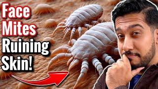 How to Get Rid of Face Mites Fast | Easy Face Mites Removal