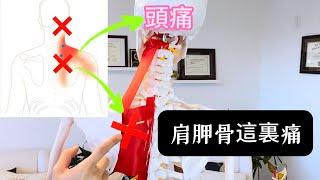 肩胛骨縫疼痛+痛頭！試試這四個簡單的方法