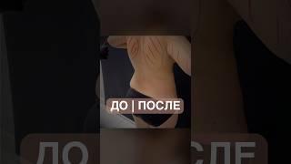 Липосакция және абдоминопластика
