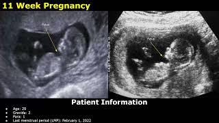 First Trimester Pregnancy Ultrasound Reporting | Obstetric USG Scan Reports | 5-12 Weeks Fetal USG