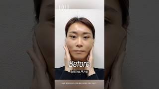 안면거상으로 늘어진 피부 고민 해결!! #shorts