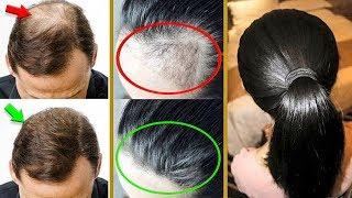 Супер-увеличение роста Волос на залысинах! Самые эффективные рецепты при Облысении