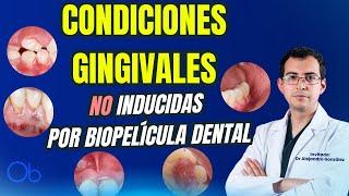 Condiciones gingivales NO inducidas por biopelícula dental con Dr Alejandro González Olacio