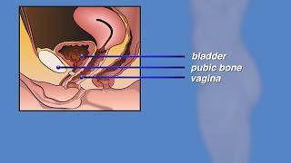 PreOp® Mesh Sling Procedure for Stress Urinary Incontinence Female