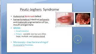 Pathology 521 f Peutz Jeghers polyp syndrome Hamartomatous small intestine dominant gross microscopy