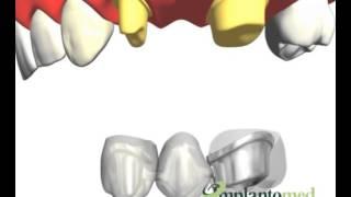 Prótese fixa metalo-ceramica sobre dente