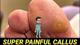 CUTTING / SHAVING OF SUPER PAINFUL BIG TOE CALLUS