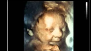 Fetal 3D Ultrasound - smiling baby