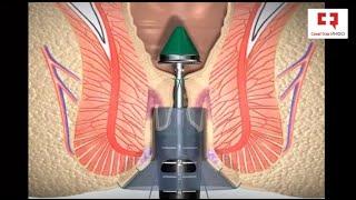 Лечение геморроя - Геморроидэктомия по Лонго: этапы и техника операции удаления внутреннего геморроя