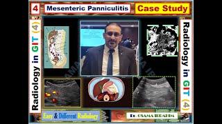 Mesenteric panniculitis - Radiology in GIT (4)