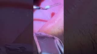 Deep Tonsil Stone Removal - Tonsil Stones - Tooth Time Family Dentistry New Braunfels Texas