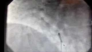 Angiography