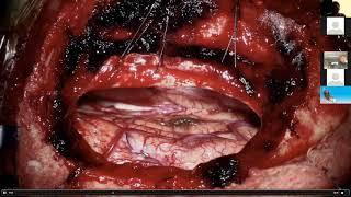 Surgery for Brainstem Cavernous Malformations by Michael Lawton MD | Neurosurgical TV