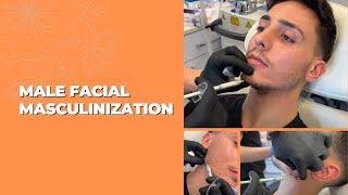 MALE FACIAL MASCULINIZATION WITH DERMAL FILLERS | Dr. Jason Emer