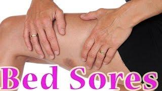 Bed Sores | Treatment For Bed Sores at Home  |  Pressure Ulcers (Decubitus Ulcer) Home Remedy