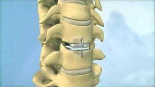 Synthes Spine ProDisc-C Cervical Total Disc Replacement Animation