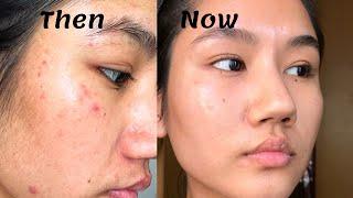 How to treat Red Acne Marks (Post-Inflammatory Erythema) | Everything you need to know about PIE |