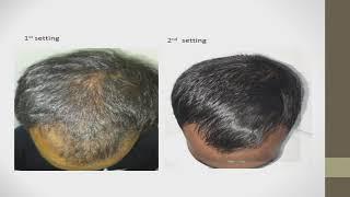 Hair fall treatment with PRP  N nose filler by Dr. Ukarande's Elite Cosmo Clinic