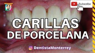 ⏭️CARILLAS de PORCELANAQuickVideo #CarillasDentales