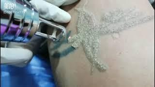 Easy Tattoo Removal with Rejuva Fresh Pico Laser Tattoo Removal Machine