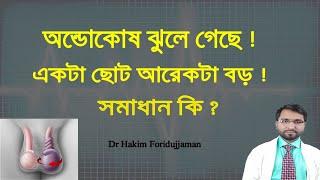 অণ্ডকোষ ঝুলে গেছে ! একটা ছোট আরেকটা বড় ! কারণ কি ও এর সমাধান কি ?