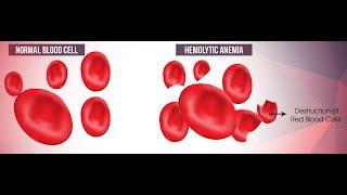 Hemolytic anemia by Dr Saif Al Kindi