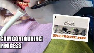 Removal of Excess Gums, Bye Gummy Smile! | Gum Contouring Procedure | Apostol Dental Philippines