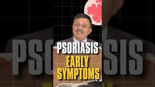 Psoriasis Early Symptoms | Psoriasis Explained | Get Answers from a Top Dermatologist