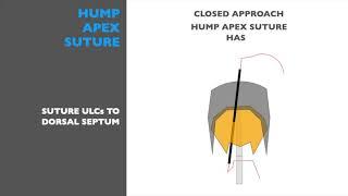 HUMP APEX SUTURE - Miguel Gonçalves Ferreira, MD, PhD