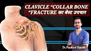 How to Spot and Treat a Broken Collarbone – Doctor’s Advice (Clavicle Fracture Explained)