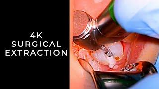 Surgical Extraction | 4K Learning | OnlineExodontia.com