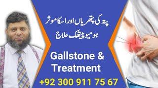 Gallstone & Treatment | Dr. Ahmed Ejaz | Urdu | Hindi | Similia Homeo Clinix | Abbottabad