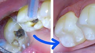  How a CAVITY & TOOTH FILLING Procedure Are Done Right by A Dentist! White Resin Composite Class 2!