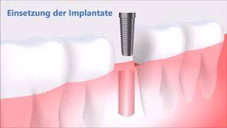 Einsetzung der Zahnimplantate