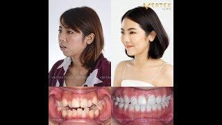 รีวิวผ่าตัดขากรรไกรร่วมกับการจัดฟันจากคนไข้ (คุณจิดาภา) l Vertex Review