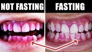  Dentist Explains How To Prevent Plaque & Cavities With Intermittent Fasting & The Stephan Curve!!