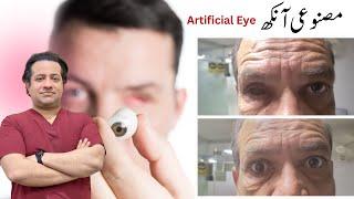 Artificial Eye | Eye Replacement Urdu/Hindi Dr. Arslan Ahmed Eye Specialist