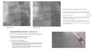 STEMI primary PCI: technical tips, including for STEMI with shock- Elias Hanna