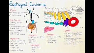 Esophageal Cancer - What you need to know