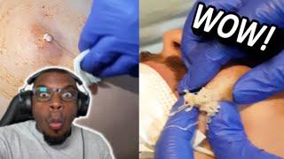Professional at home Pimple Poppers, Pop CYST!