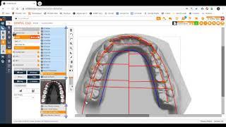 Mixed Dentition Model Measuring in D-Cad