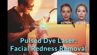 Pulsed Dye Laser: Facial Redness Removal - with Dr. Sameer Bashey | Over 50