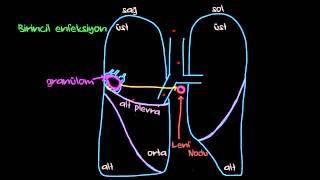 Birincil ve İkincil Verem (Sağlık: Verem) (Bulaşıcı Hastalıklar)