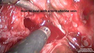 Uterine vein tear and how to deal with it