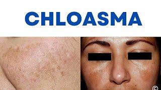 What is Chloasma? Chloasma vs Melasma, Mask of Pregnancy, What causes Chloasma? Chloasma Treatment