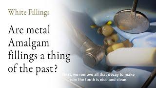 Are metal Amalgam fillings a thing of the past?