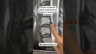Грыжа в шейном отделе позвоночника. Результат лечения без операции. #грыжадиска #позвоночник