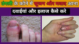 ऊँगली के कोने में सुजन और पस निकलना | paronychia treatment | paronychia in hindi | Medical jankari